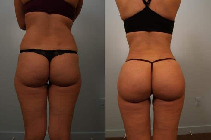 Brazalian Buttock by LuxLipo