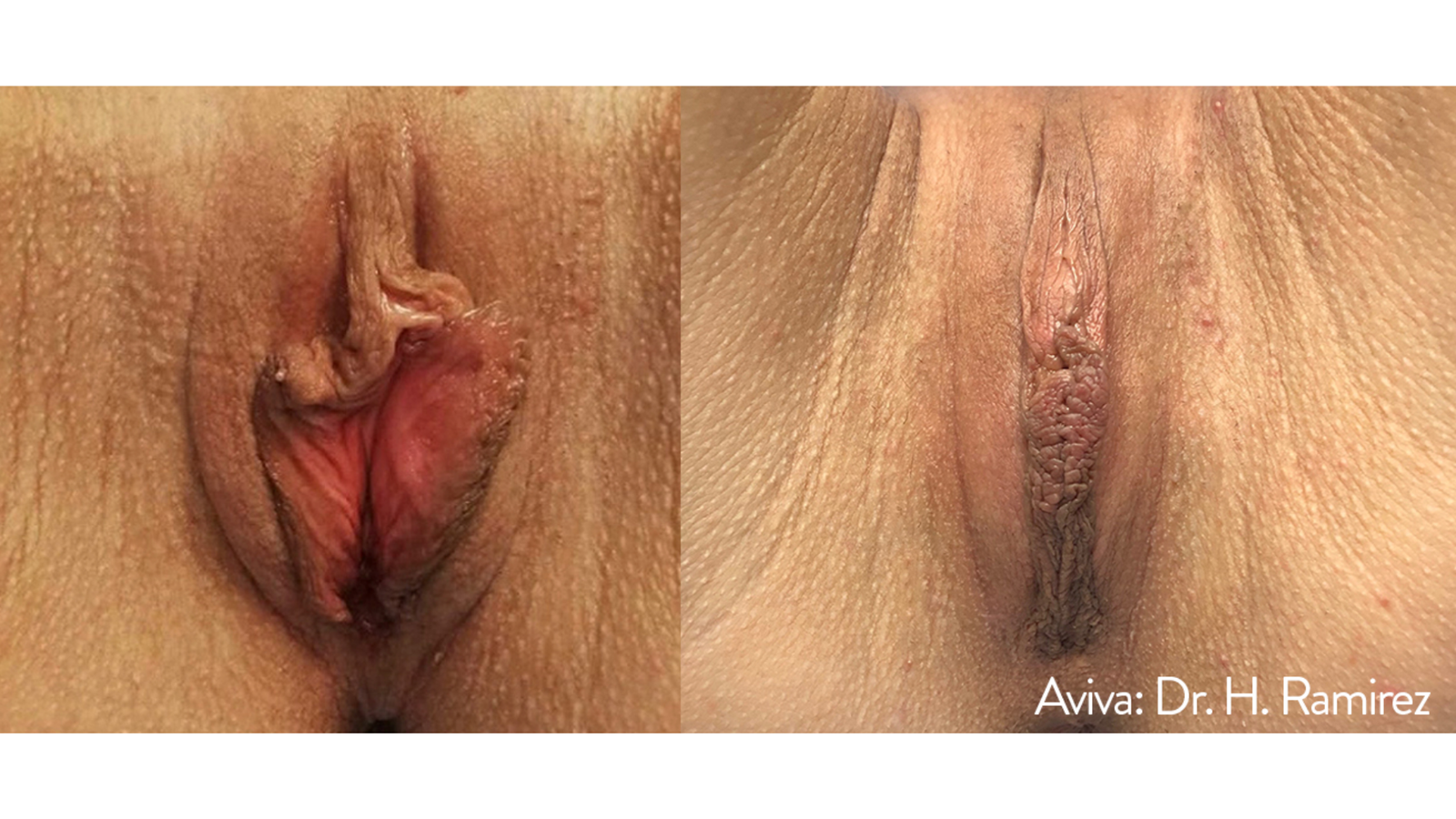 Sensitive Treatment 4