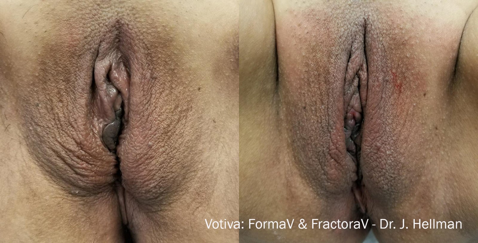 Sensitive Treatment 2