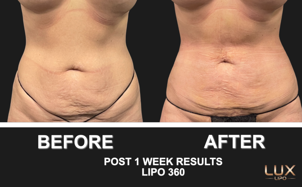 Before and after neck liposuction results
