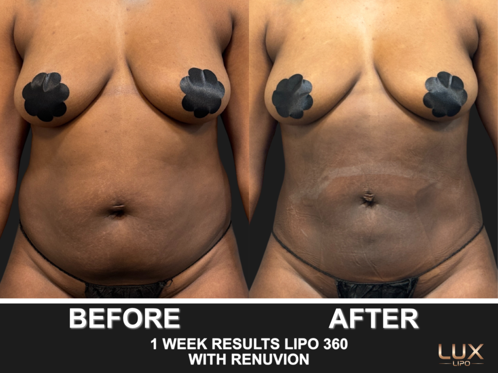 Before and after liposuction results