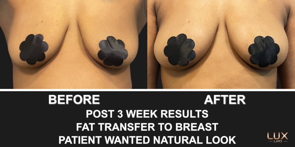 Fat Transfer to Breast Before and After 3 Weeks