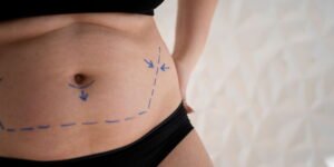 How Long Do Tumescent Liposuction Results Last?
