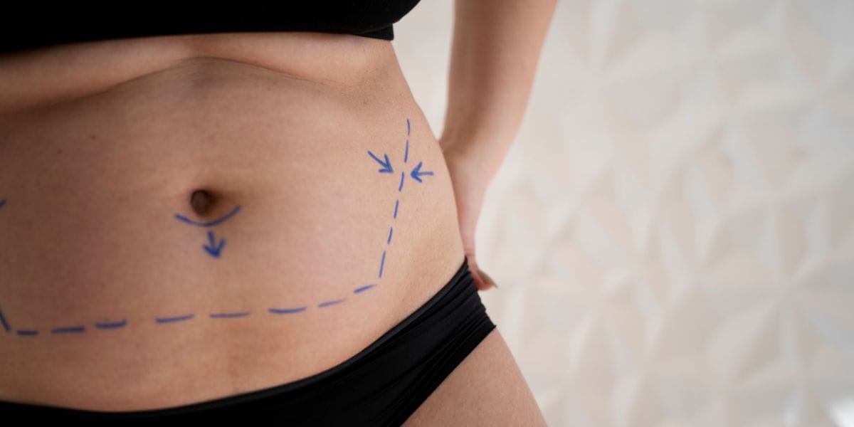 How Long Do Tumescent Liposuction results Last