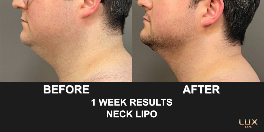 Neck Lipo Before and After 1 Week