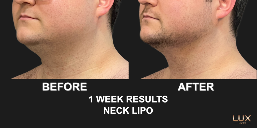 Neck Lipo Transformation 1 week