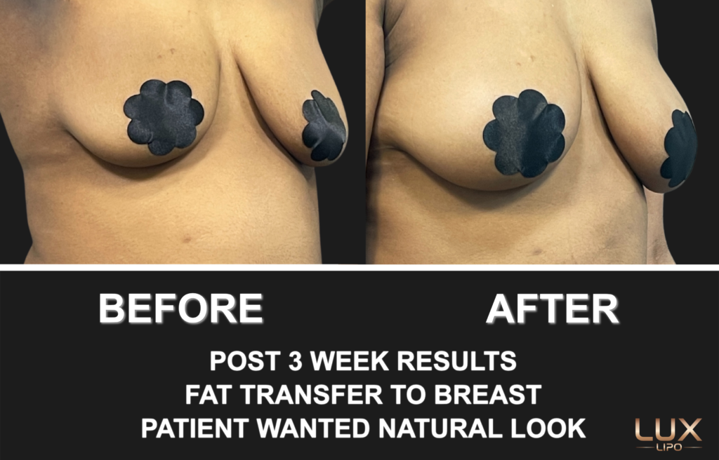 Fat Transfer to Breast 3 Week Before and After