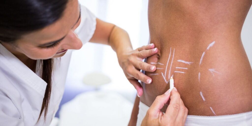 does tumescent liposuction tighten skin​