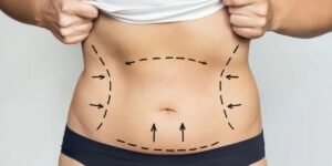 Why Choose Awake Liposuction Over Liposuction Under General Anesthesia?