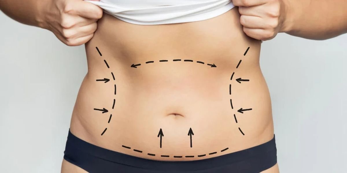 Cosmetic surgeon performing awake liposuction procedure on patient in a clinical setting with local anesthesia equipment, illustrating minimally invasive body contouring compared to general anesthesia procedures | Is Awake Liposuction Better Than General Anesthesia