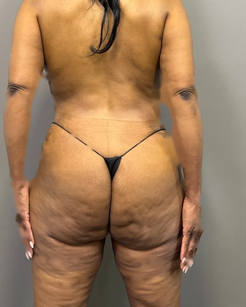 One month after fat transfer, hip dips, with lipo