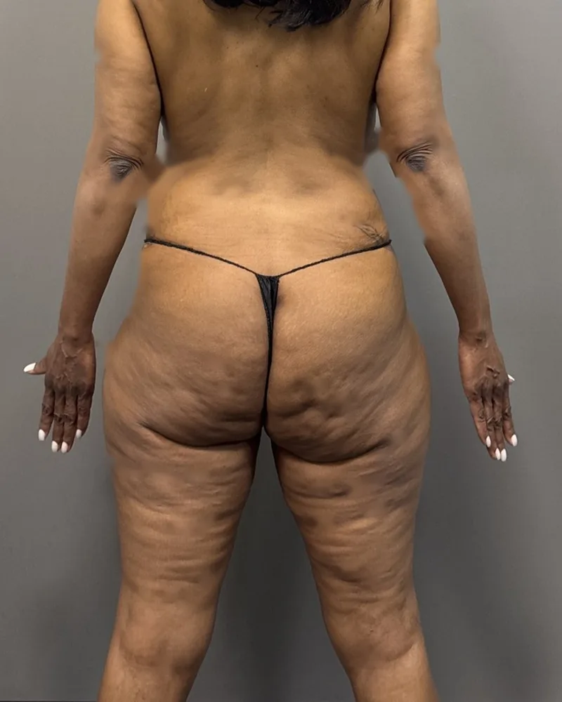 Before fat transfer, hip dips, with lipo