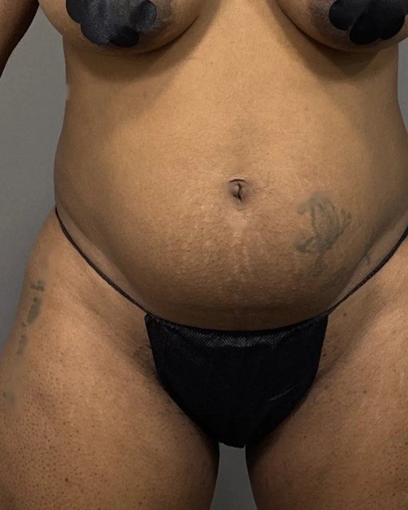 Before awake liposuction, abdomen and flanks