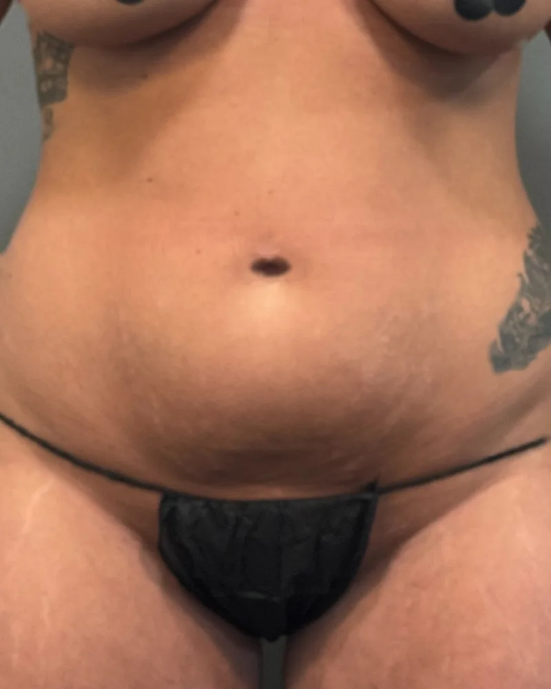 Before awake liposuction, abdomen and flanks, with Renuvion