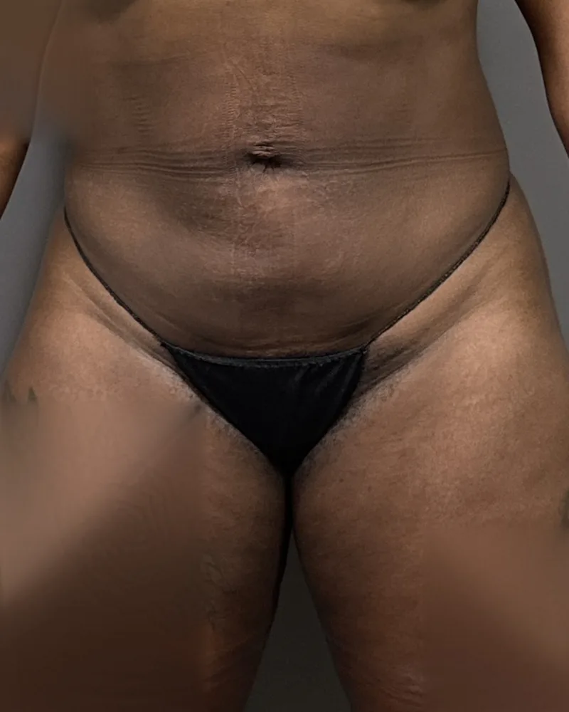 One month after awake liposuction, abdomen and flanks, with Renuvion