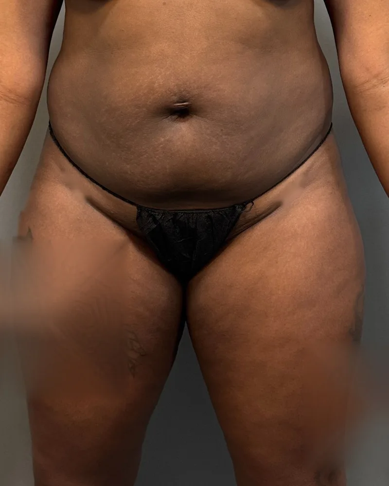 Before awake liposuction, abdomen and flanks, with Renuvion