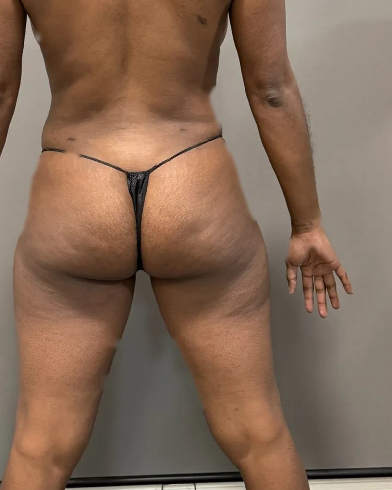 Three months after awake liposuction, back and flanks