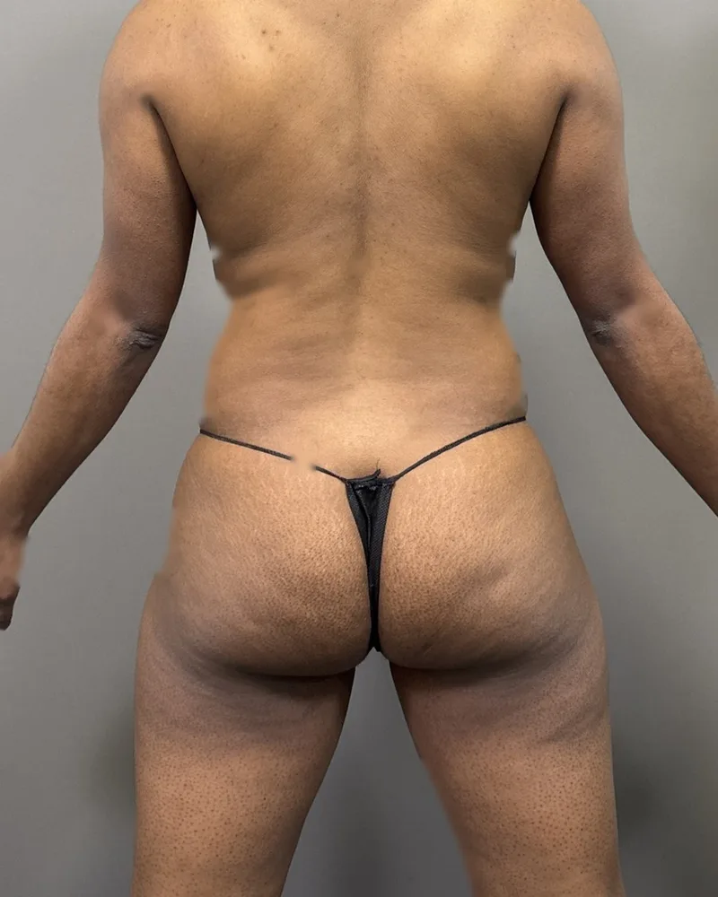 Before awake liposuction, back and flanks