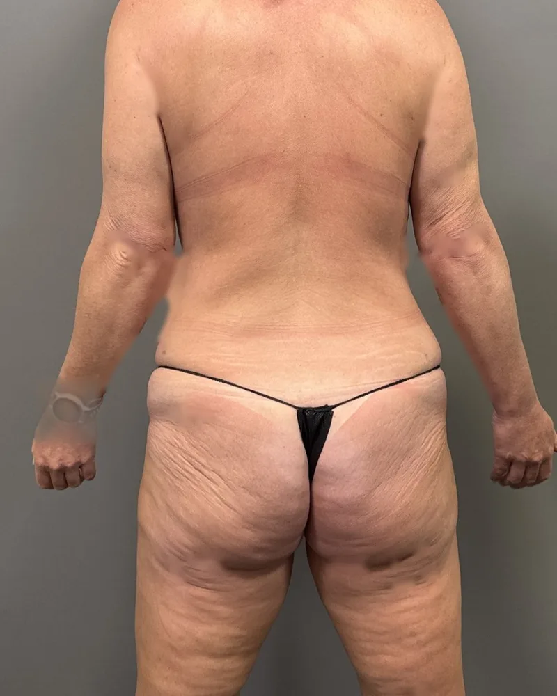 Three months after awake liposuction, back and flanks, with Renuvion