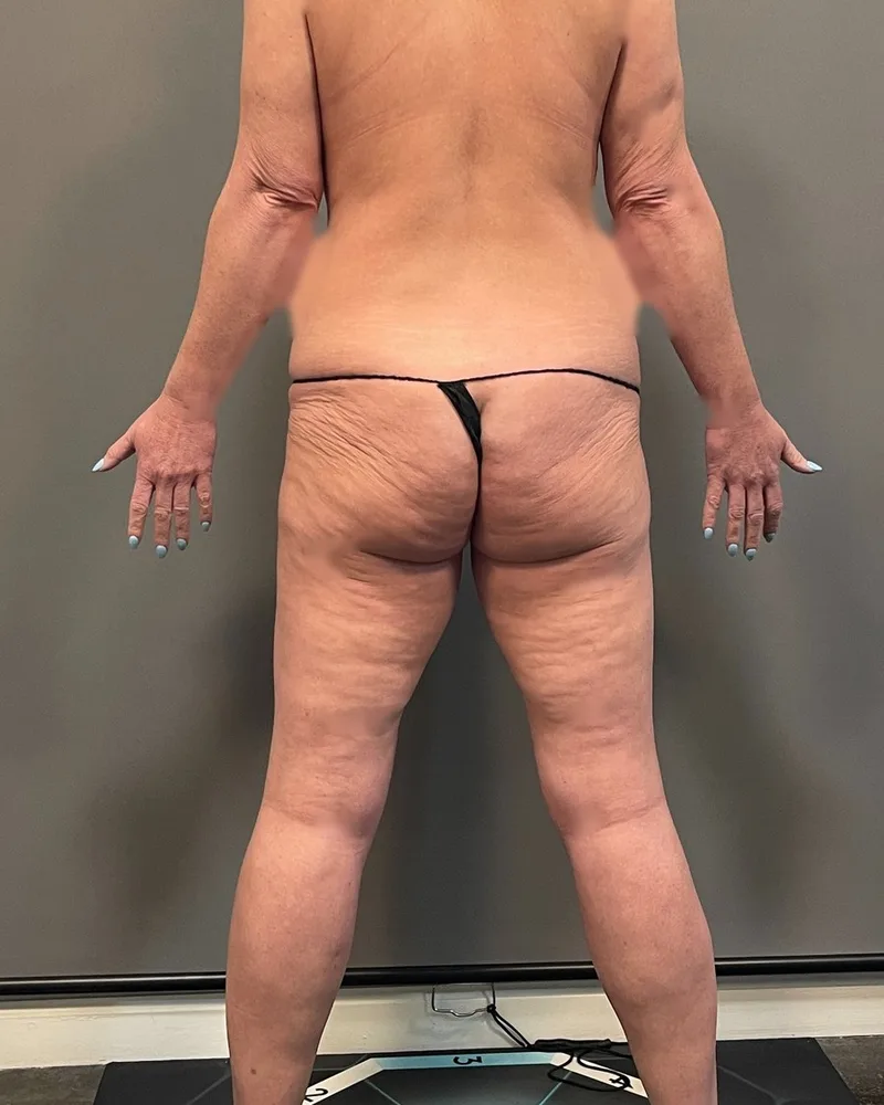 Before awake liposuction, back and flanks, with Renuvion