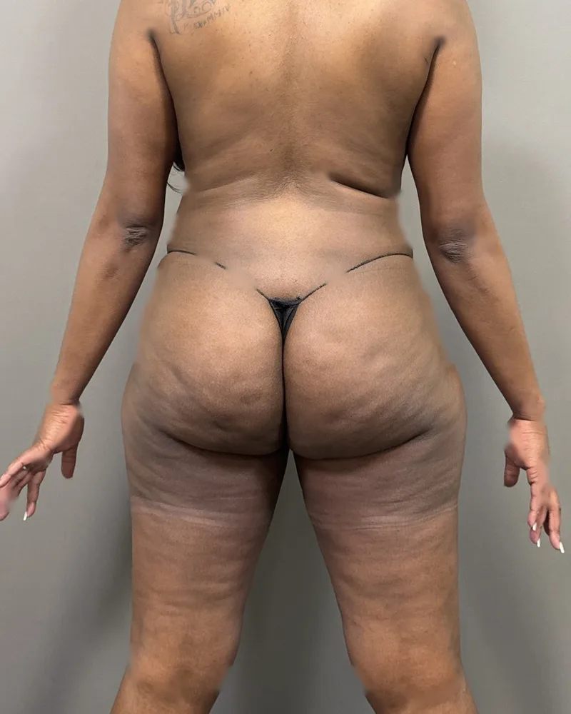 One month after awake liposuction, back and flanks, with Renuvion