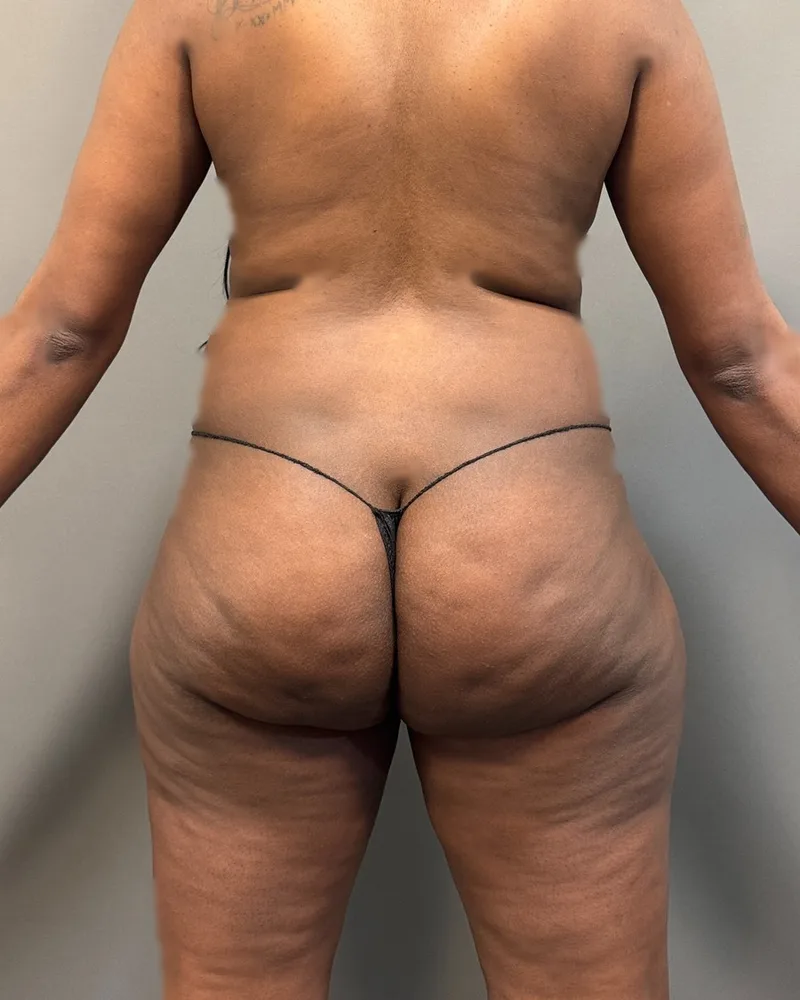 Before awake liposuction, back and flanks, with Renuvion