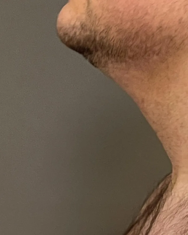 Ten days after awake liposuction, neck and jawline, with Renuvion