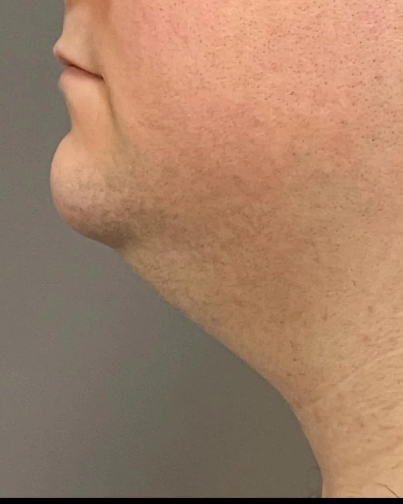 Before awake liposuction, neck and jawline, with Renuvion