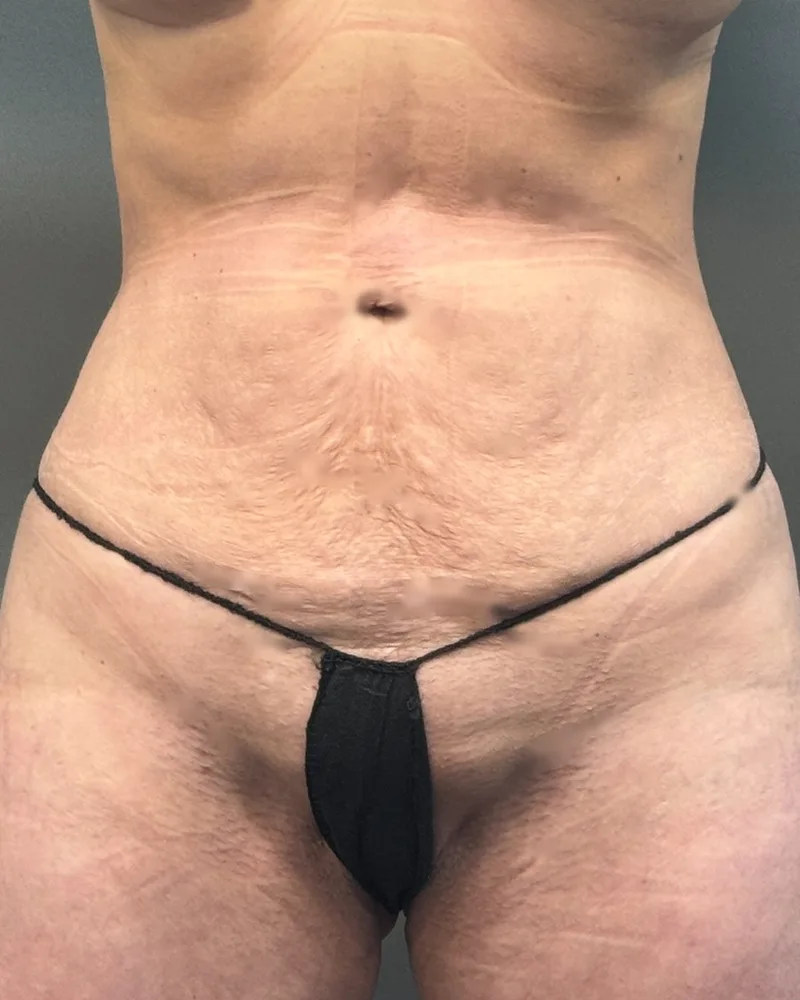 Renuvion, abdomen and flanks, with awake lipo, after, 1 month