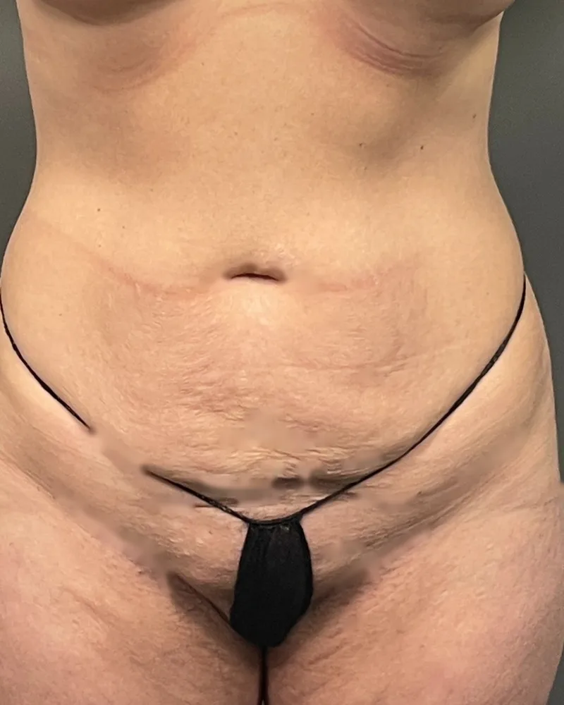 Renuvion, abdomen and flanks, with awake lipo, before