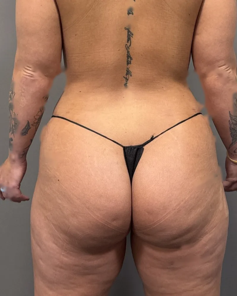 Renuvion, back and flanks, with awake lipo, after, 3 months