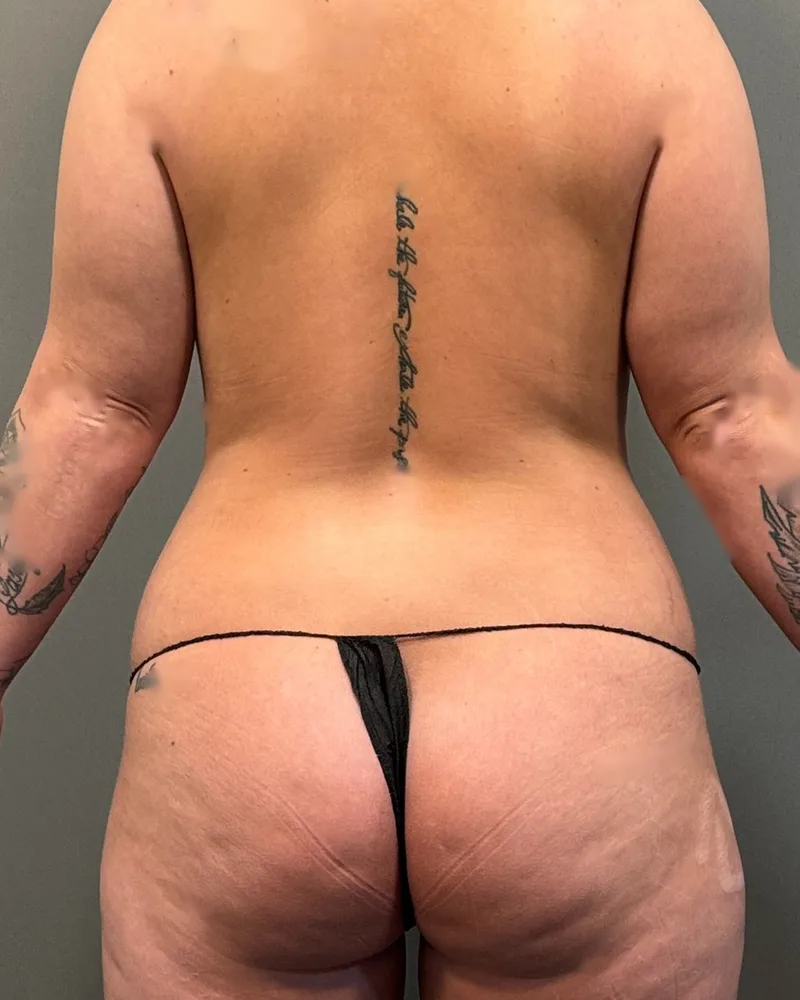 Renuvion, back and flanks, with awake lipo, before