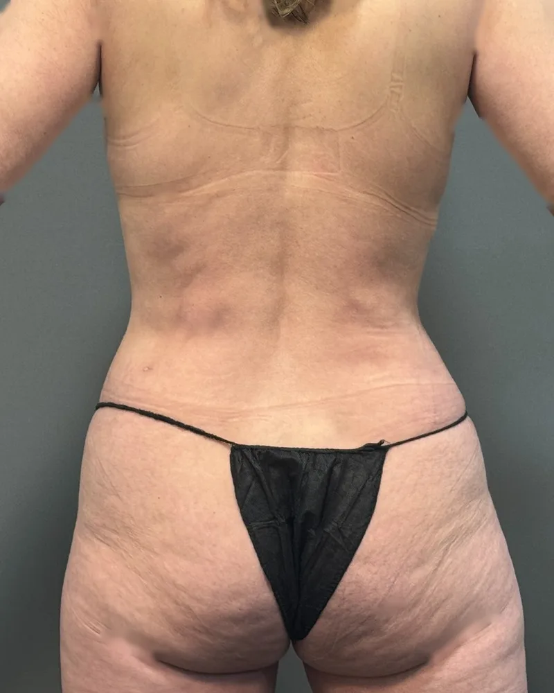 One month after Renuvion, back and flanks, with awake lipo