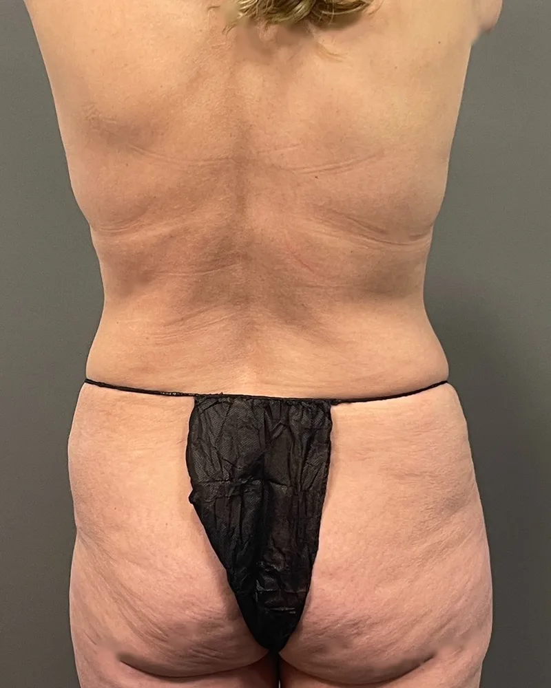 Before Renuvion, back and flanks, with awake lipo